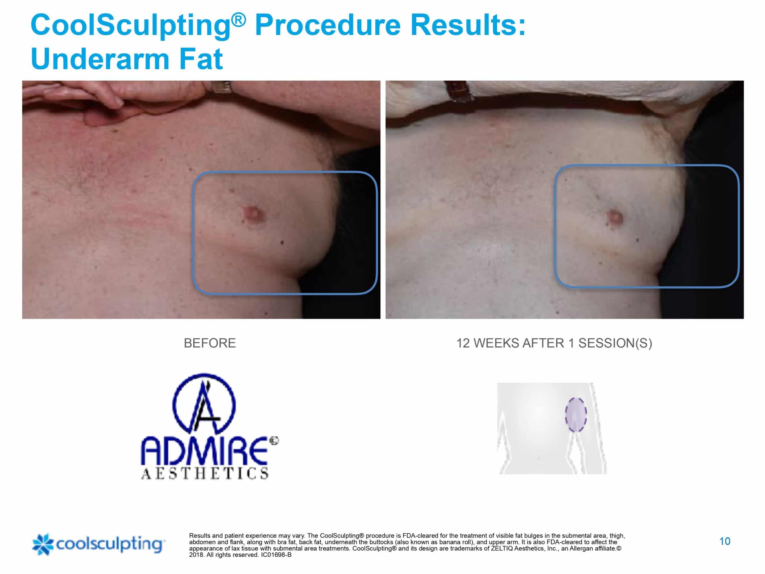 Mans chest before and after coolsculpting elite treatment.