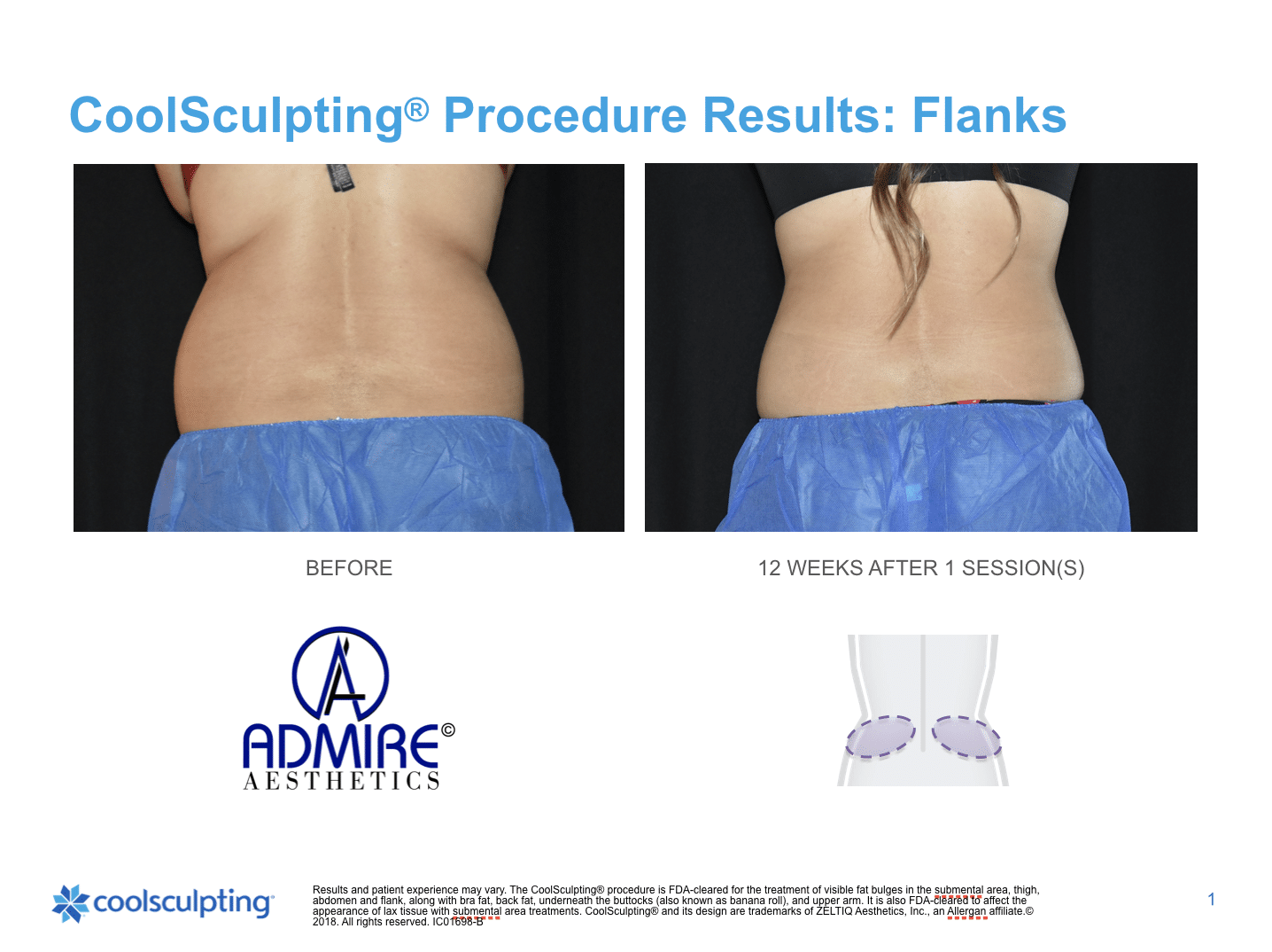 Womans back flanks before and after Coolsculpting treatment at Admire Aesthetics in Medford, OR.