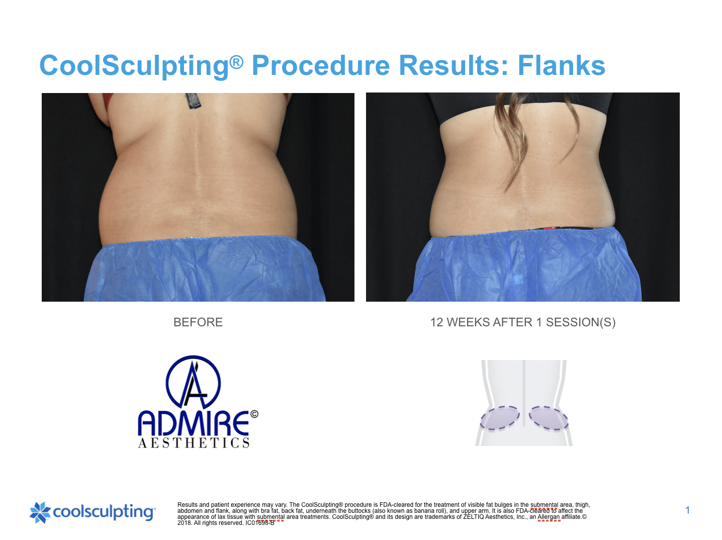 CoolSculpting Elite, reducing fat on tummy & flanks, before and after