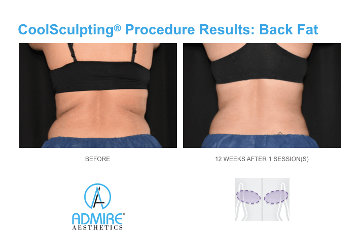 Womans back flanks before and after Coolsculpting treatment.