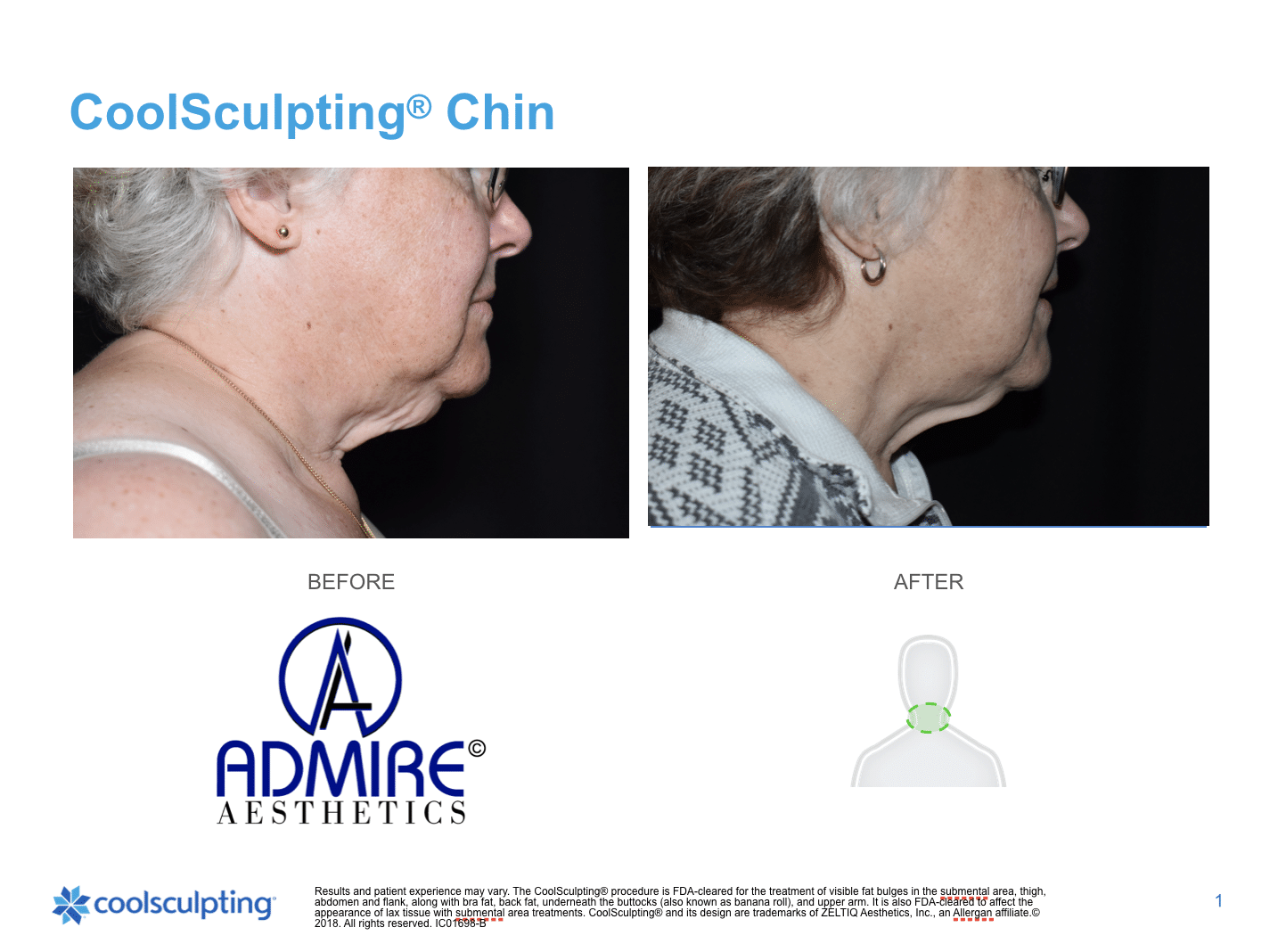 Woman's before and after coolsculpting treatment to submental chin area by Admire Aesthetics in Medford, OR.
