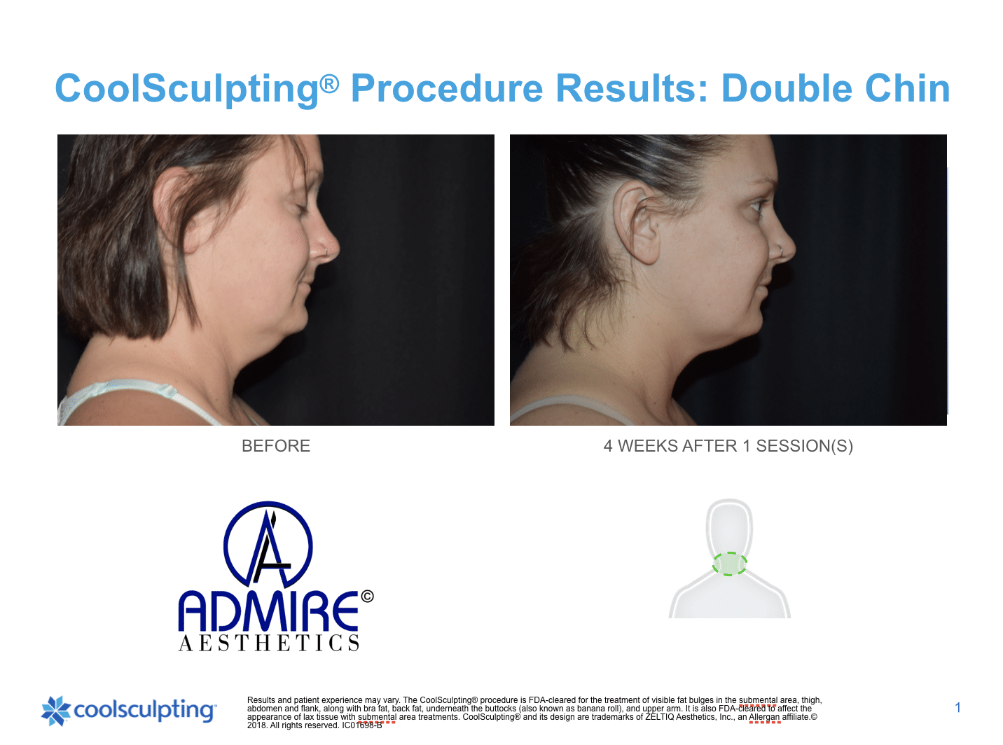 Woman's before and after coolsculpting treatment to submental chin area by Admire Aesthetics in Medford, OR.