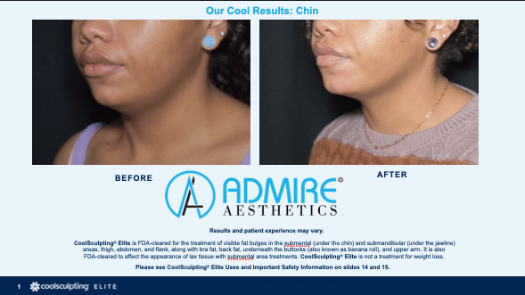 Womans submental chin before and after coolsculpting Elite treatment at Admire Aesthetics in Medford, OR.