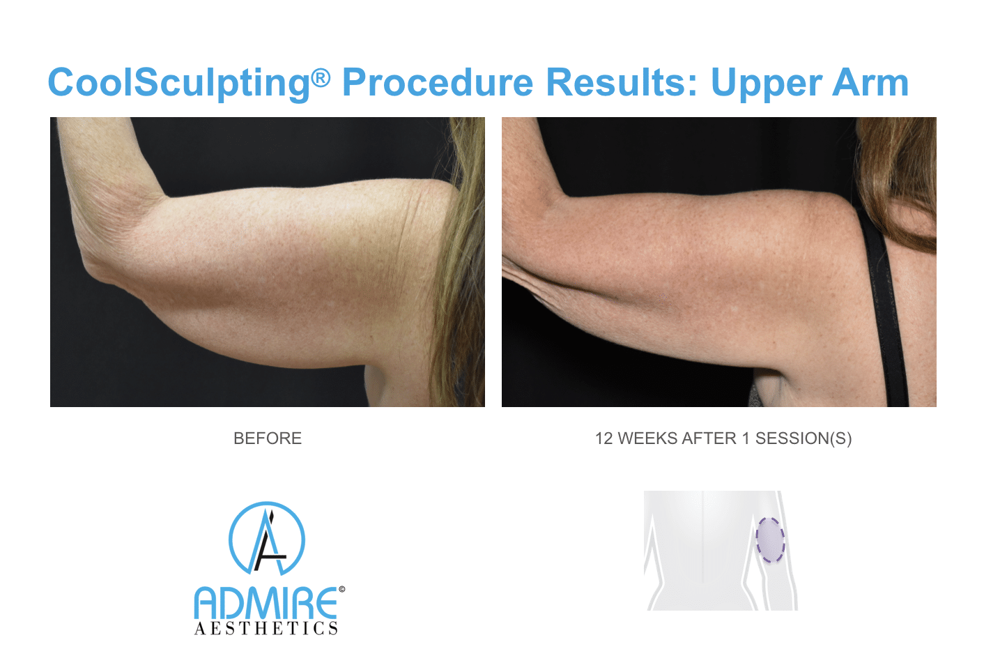 Womans under arms before and after coolsculpting treatment at Admire Aesthetics in Medford, OR.