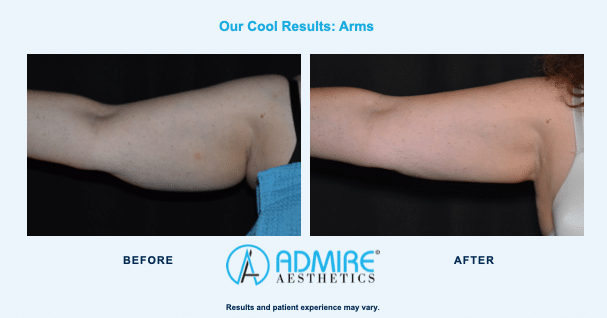 Arms before and after Coolsculpting Elite treatment.