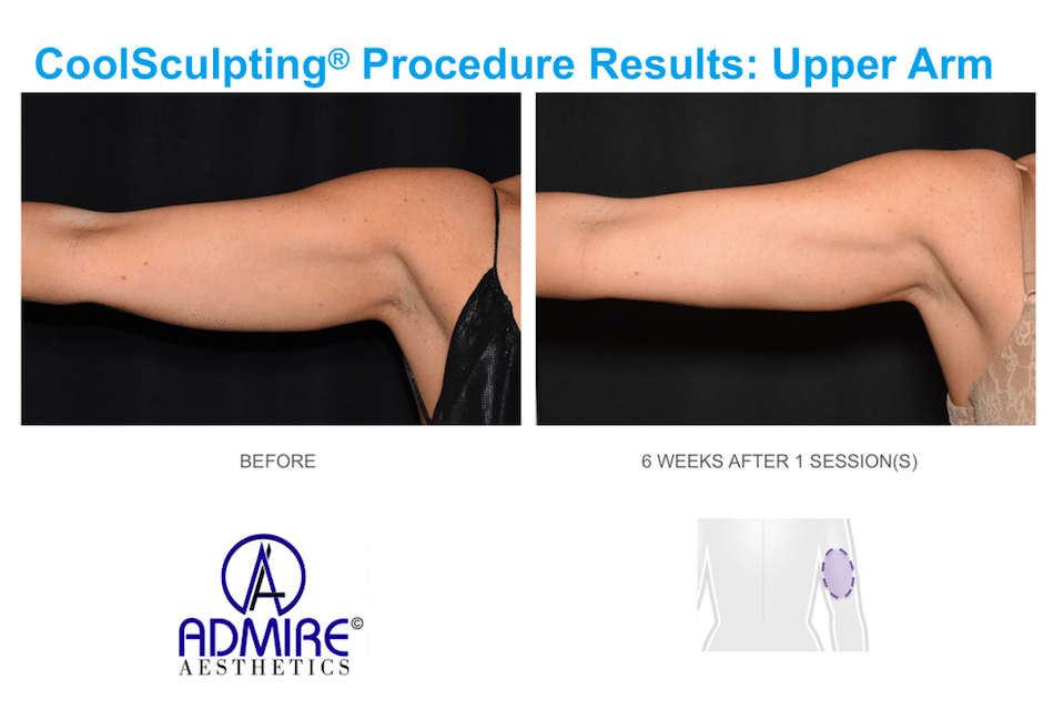 Womans under arms before and after coolsculpting treatment at Admire Aesthetics in Medford, OR.