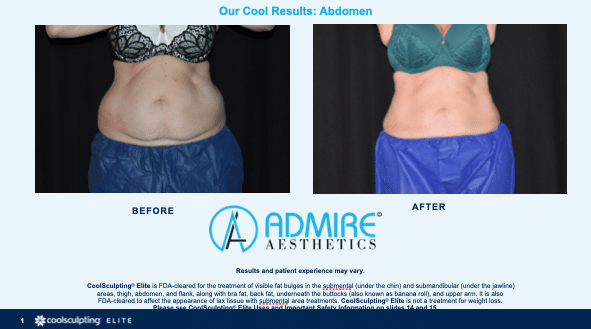 Womans abdomen before and after coolsculpting elite treatment.