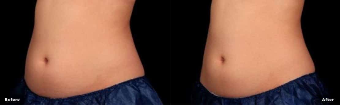 TruSculpt iD before and after results of Abdominal treatment area.