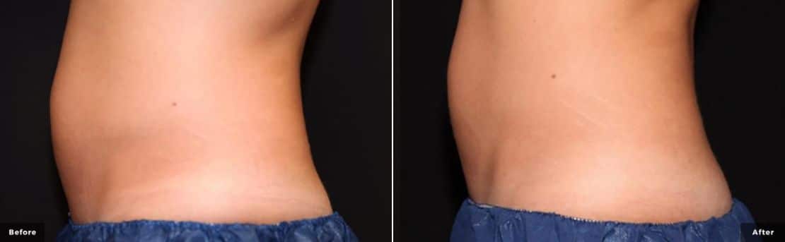 Side profile of a patients abdomen with TruSculpt iD before and after results.