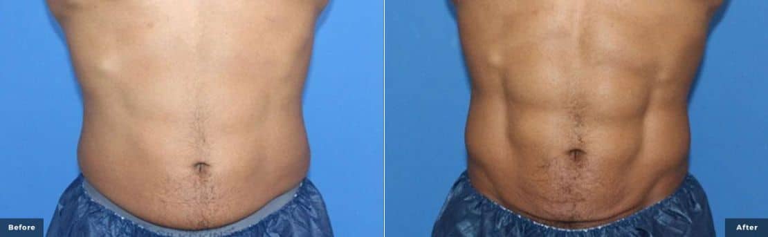 Abdomen showing before and after trusculpt flex results.