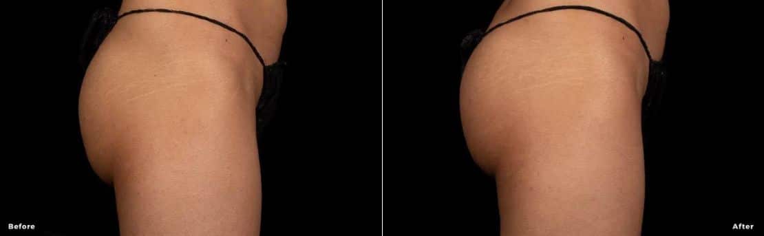 Buttocks before and after trusculpt flex treatment.