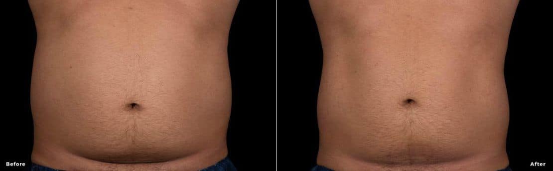 Before and after trusculpt flex treatment results.