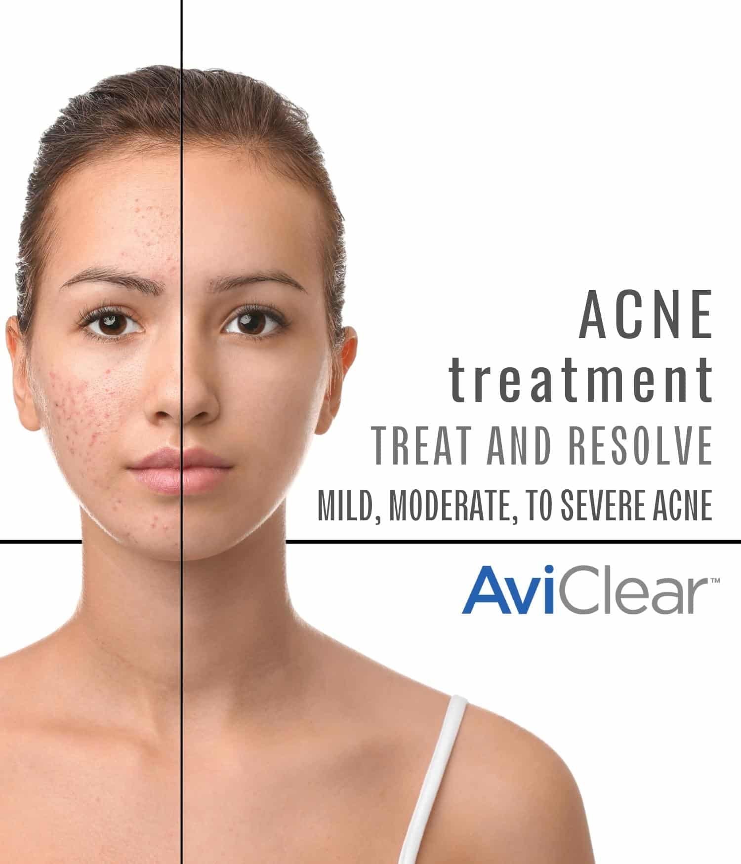 Woman's face showing before and after aviclear acne treatment benefits.