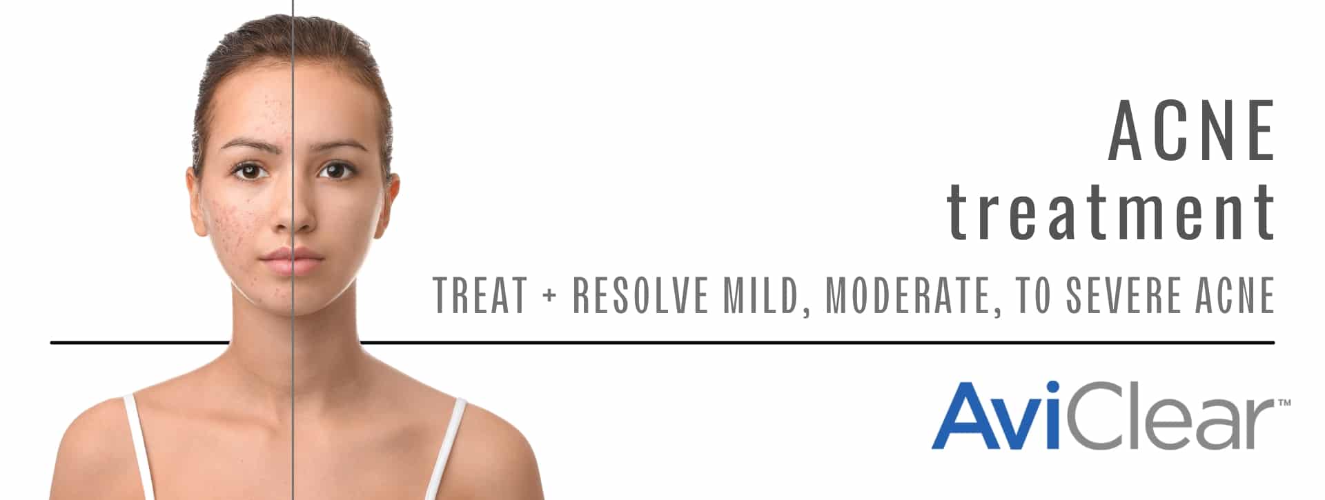 Woman's face showing before and after aviclear acne treatment benefits.