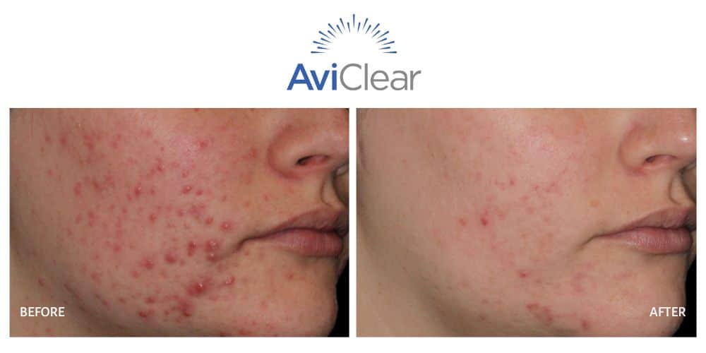 Before and after aviclear acne treatment with significant improvement.