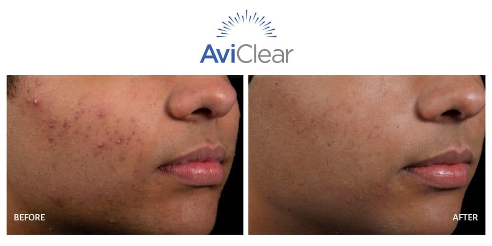 Face showing before and after results from aviclear acne treatment.