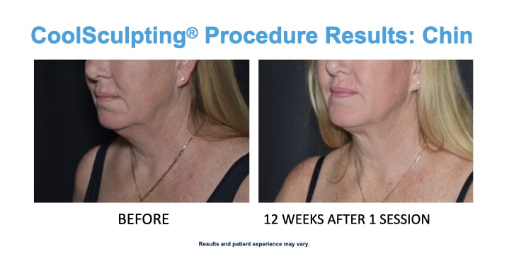 CS-Chin-Results-Woman