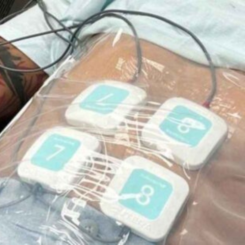 man getting trusculpt on his stomach