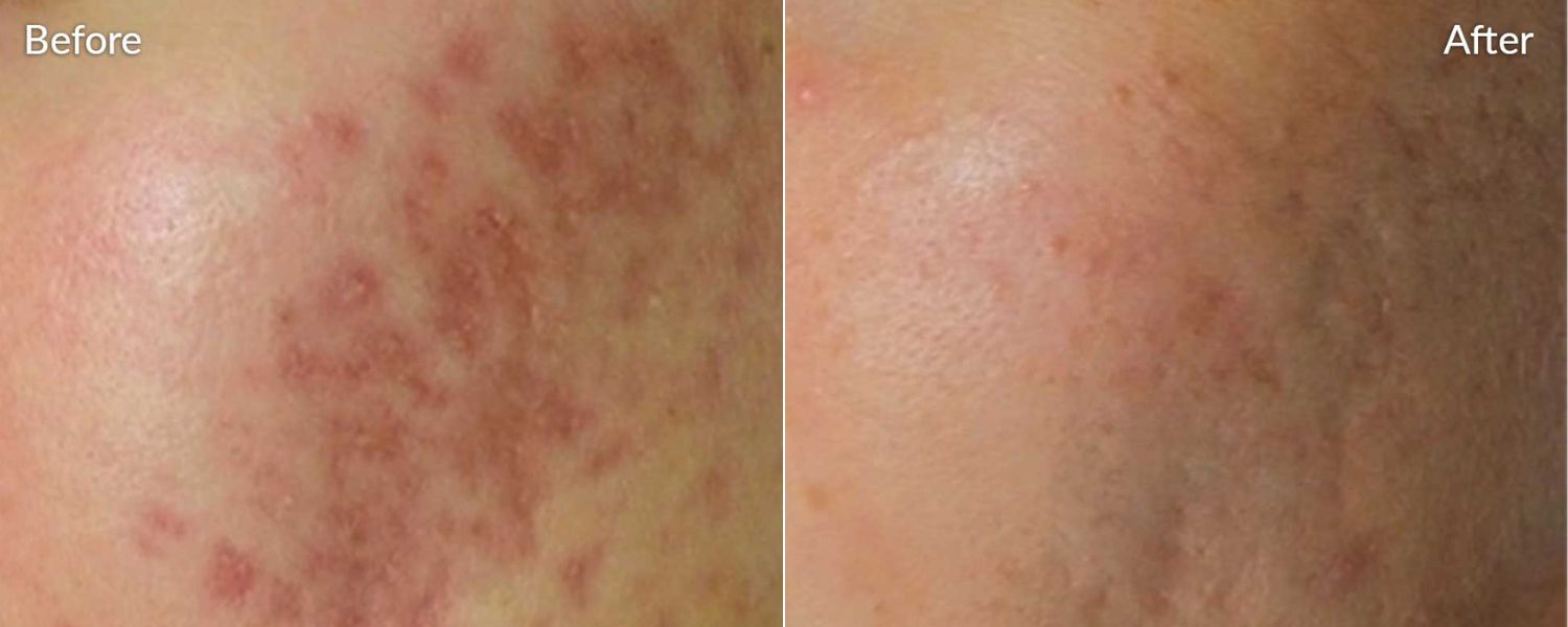 An image of before and after microneedling treatment.