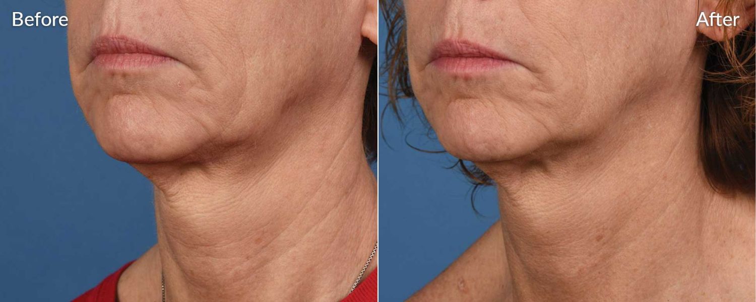 An image of before and after microneedling treatment.