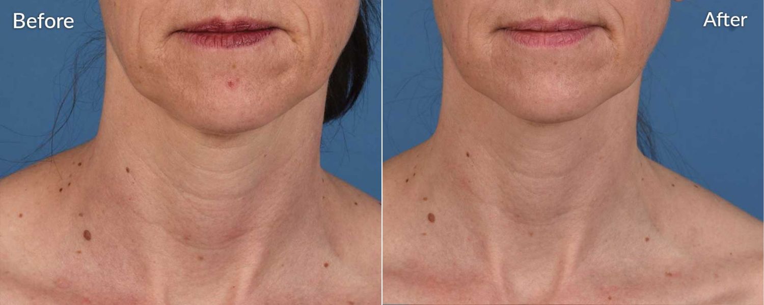 An image of before and after microneedling treatment.
