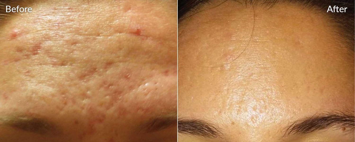 An image of before and after microneedling treatment.