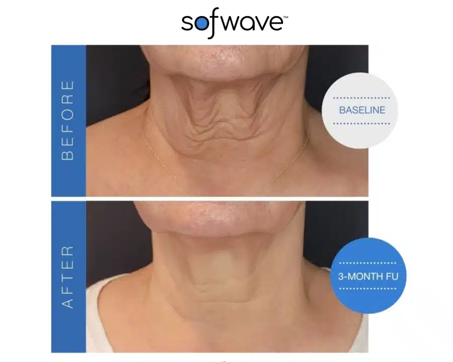 Sofwave before and after photos of a woman's neck area showing a tighter and smoother skin.
