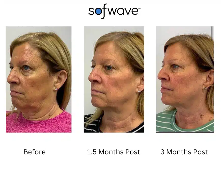 Sofwave before and after photos of a woman's face showing a tighter and smoother skin.