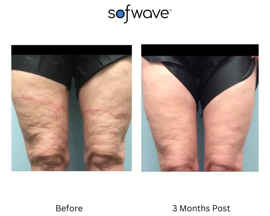 Sofwave before and after photos of a woman's thighs showing a reduced cellulite resulting in a more smoother skin.