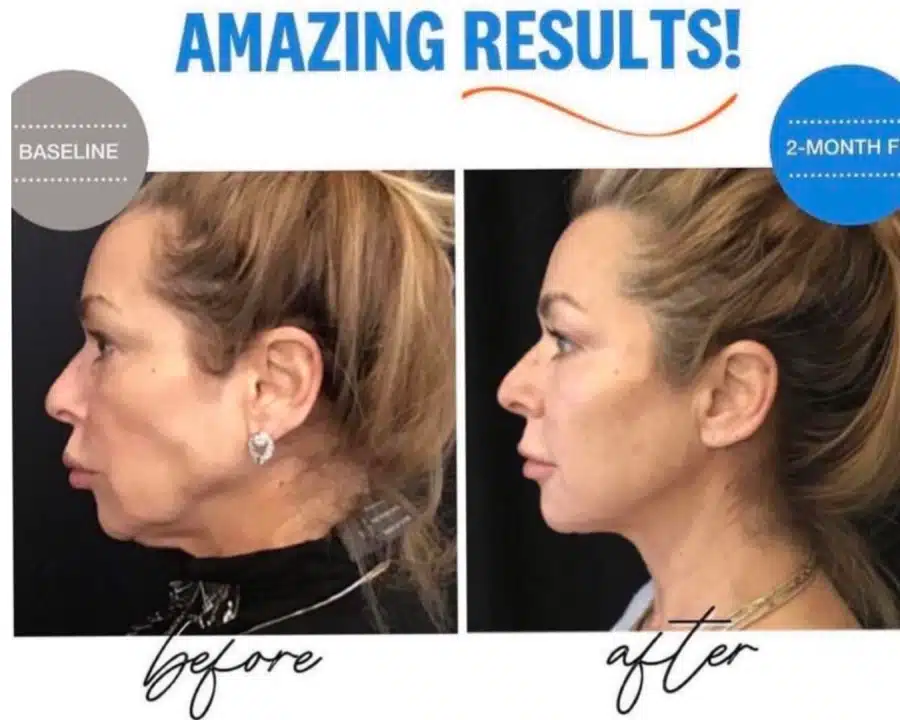 Sofwave before and after photos of a woman's face sideview.