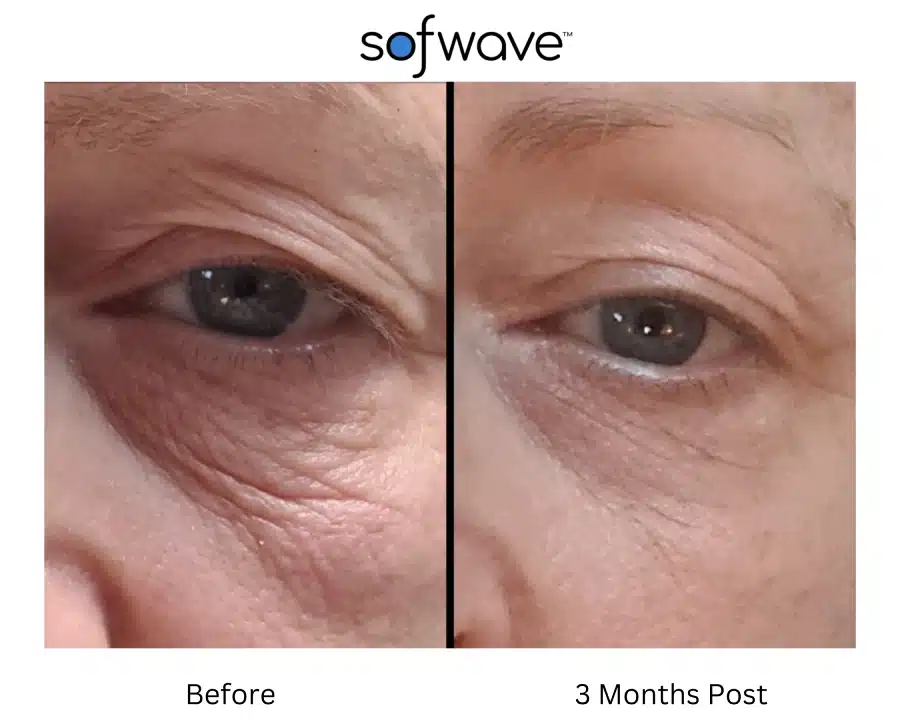 Sofwave before and after photos of a woman's face, closeup shot of her eye.
