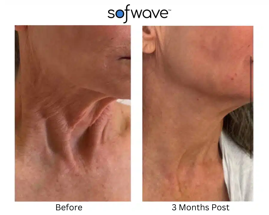 Sofwave before and after photos of a woman's neck area showing a tighter skin.