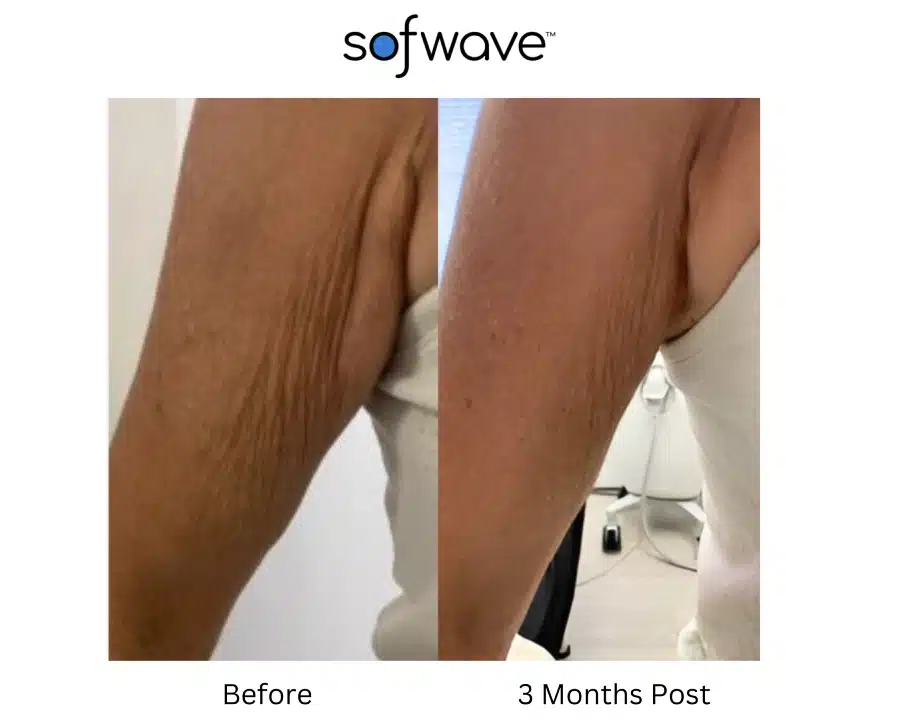 Sofwave before and after photos of a patient's arm showing a tighter skin result.