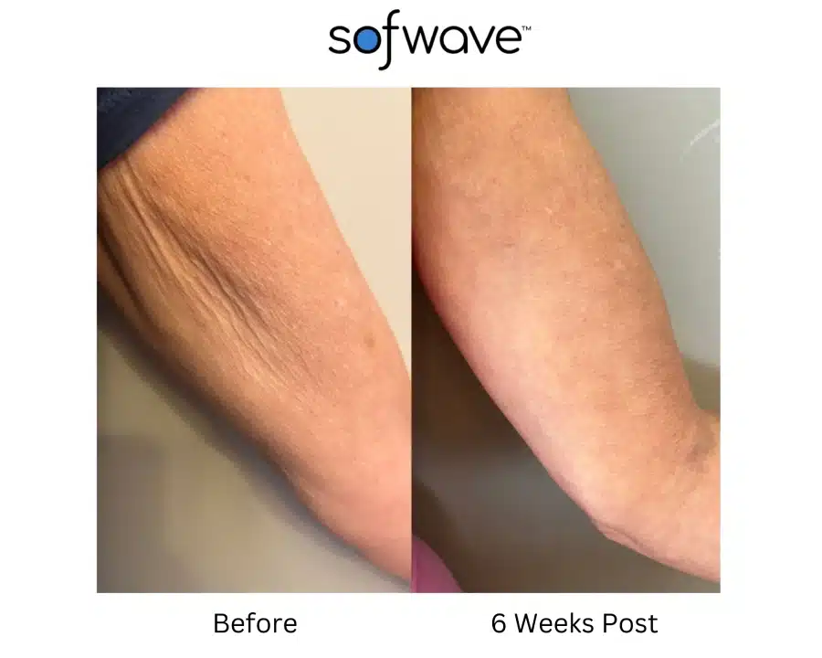 Sofwave before and after photos of a patient's arm showing a tighter skin result.