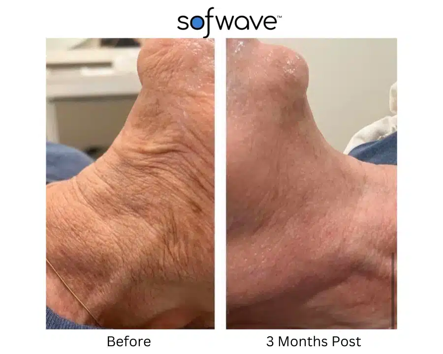 Sofwave before and after photos of a woman's neck area showing a tighter skin.