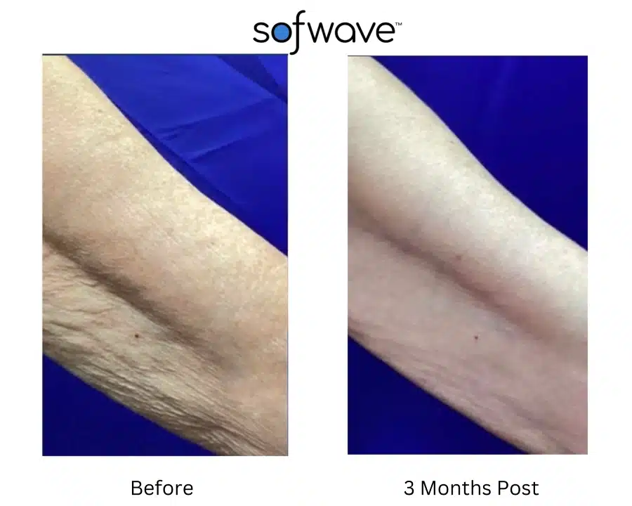 Sofwave before and after photos of a patient's arm showing a tighter skin result.
