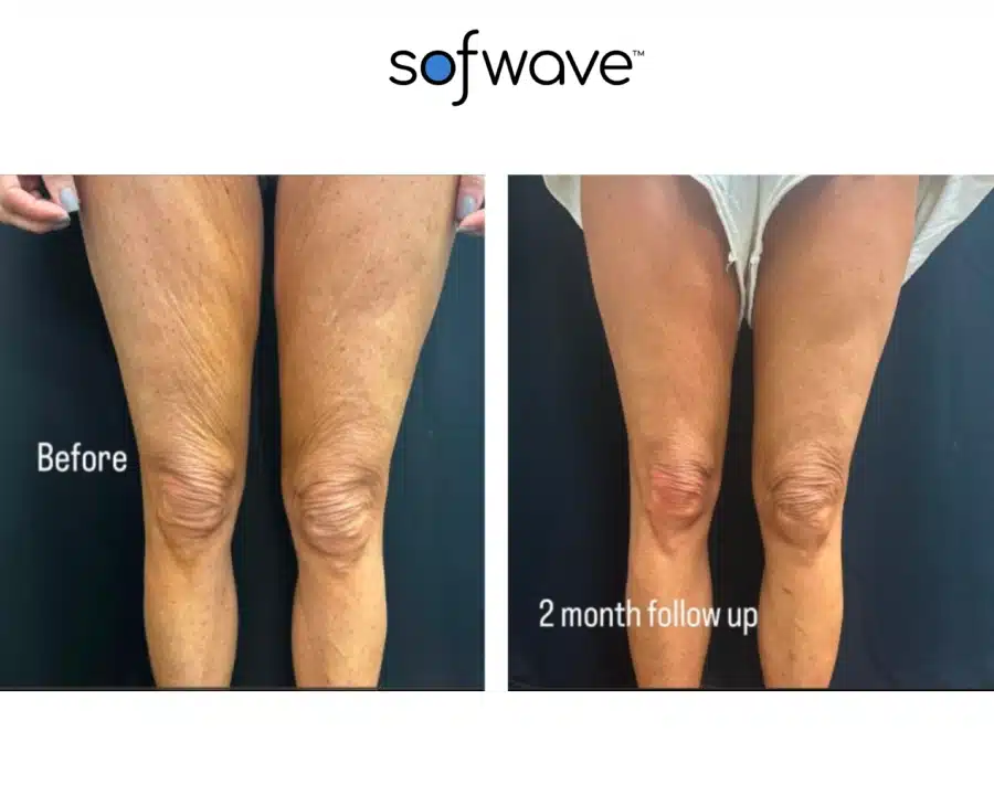 Sofwave before and after photos of a woman's legs showing a tighter and smoother skin.