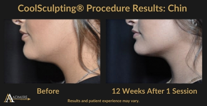 AA - CoolSculpt Chin 1a