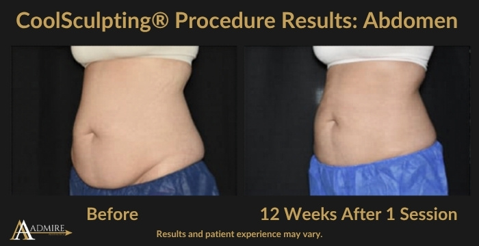 AA - CoolSculpting® Procedure Results Abdomen