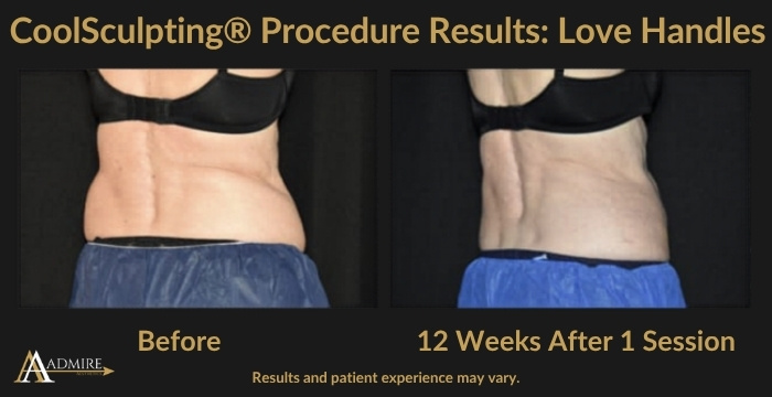 AA - CoolSculpting® Procedure Results Love Handles