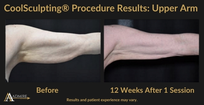 AA - CoolSculpting® Procedure Results Upper Arm 1a