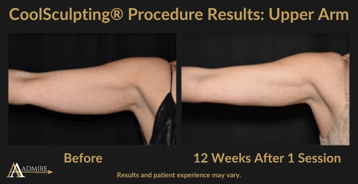 AA - CoolSculpting® Procedure Results Upper Arm 1b