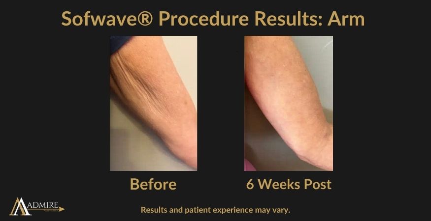 _AA - Sofwave® Procedure Results Arm