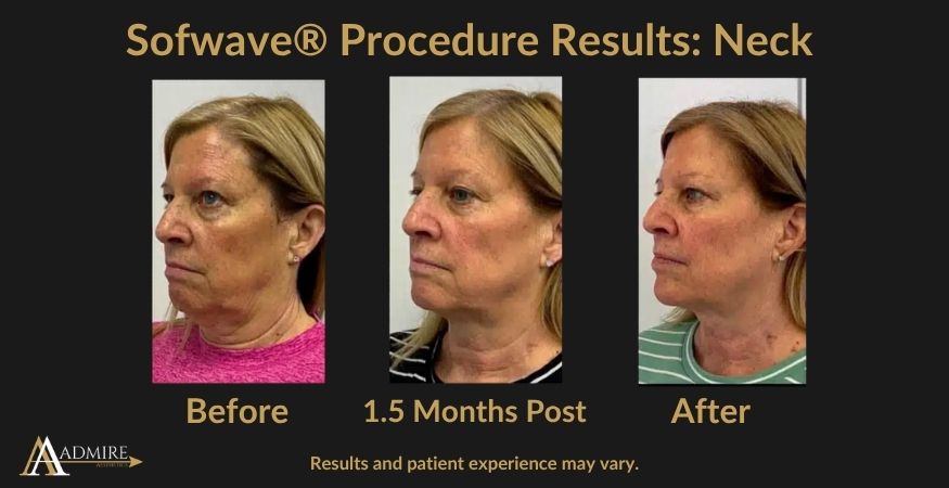_AA - Sofwave® Procedure Results Neck