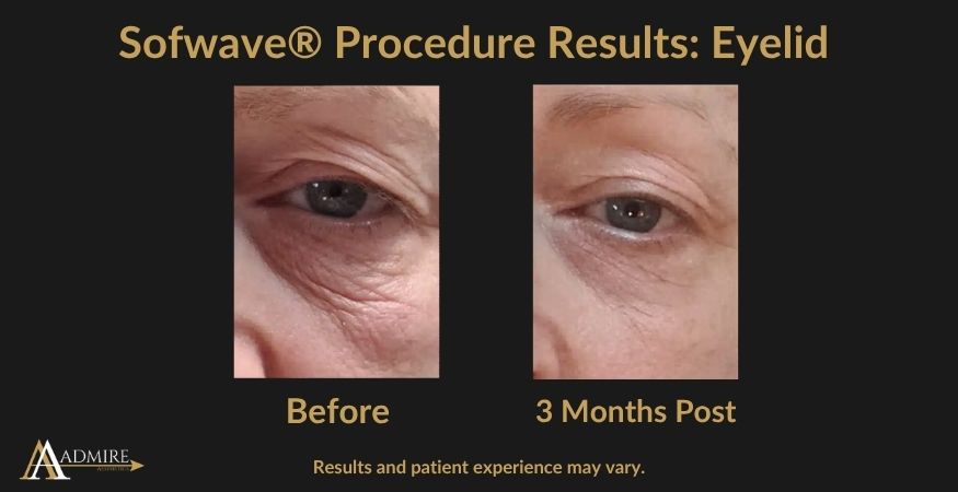 _AA - Sofwave® Procedure Results Neck (1)