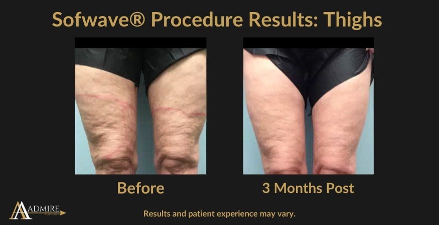 _AA - Sofwave® Procedure Results Neck (2)