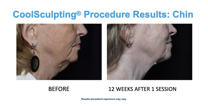 CS Chin blond Older woman