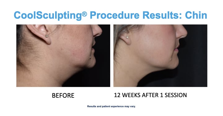 CS Chin results younger woman