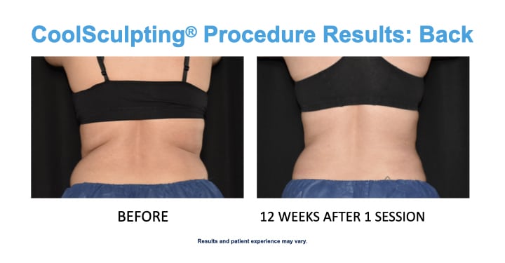 CS back results woman